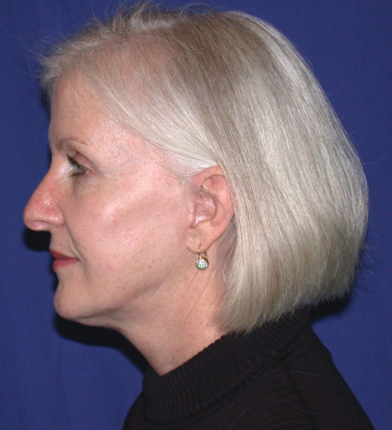 After Face Lift Surgery by Dr. Bermudez in San Francisco