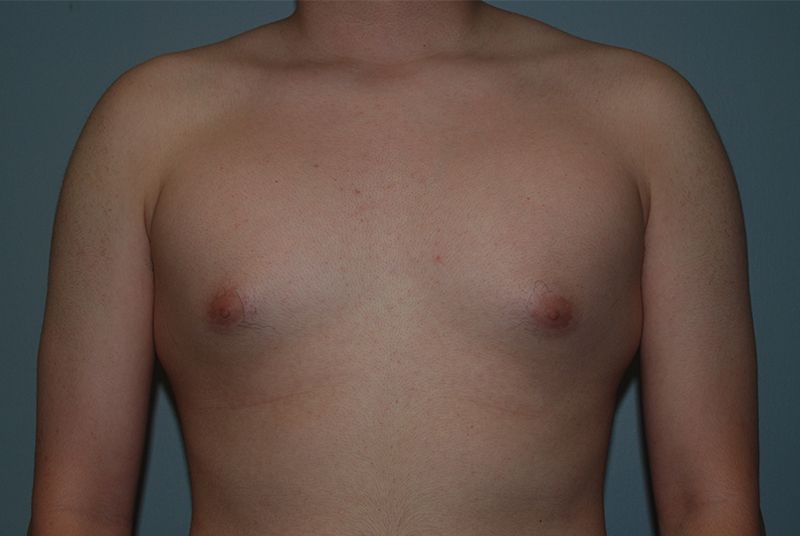 Male Breast Reduction - Before