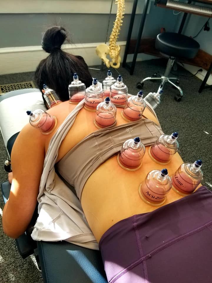 Cupping for Lower Back Pain, Does It Work?