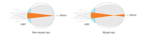 Myopia Control Education