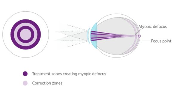 Myopia Control