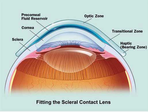 refractive