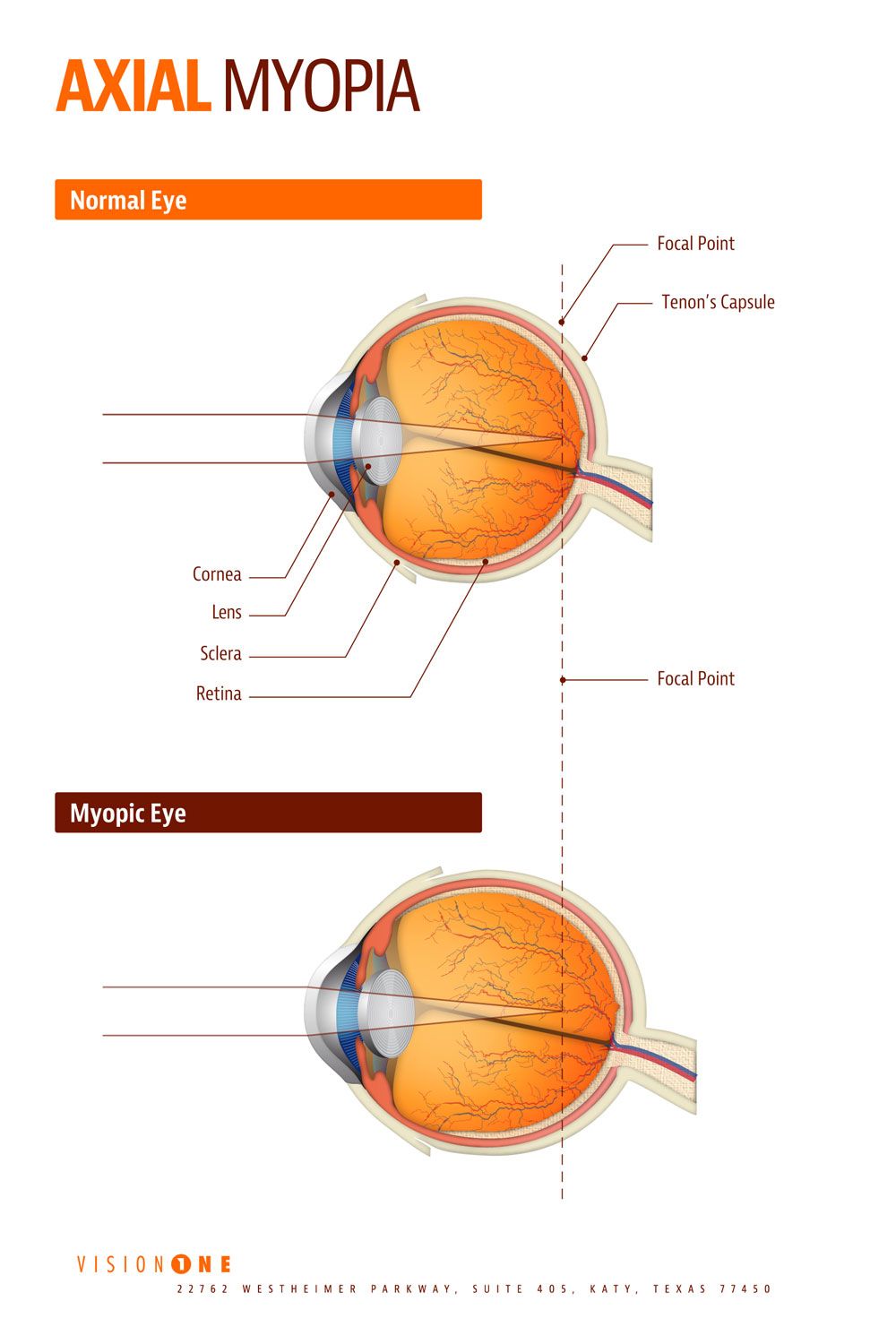 Myopia Control