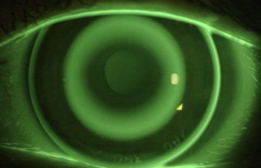 Orthokeratology Myopia Management: Slowing Down Nearsightedness Progression