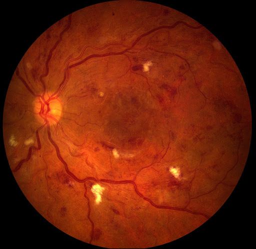  Fundus Photo diabetic retinopathy
