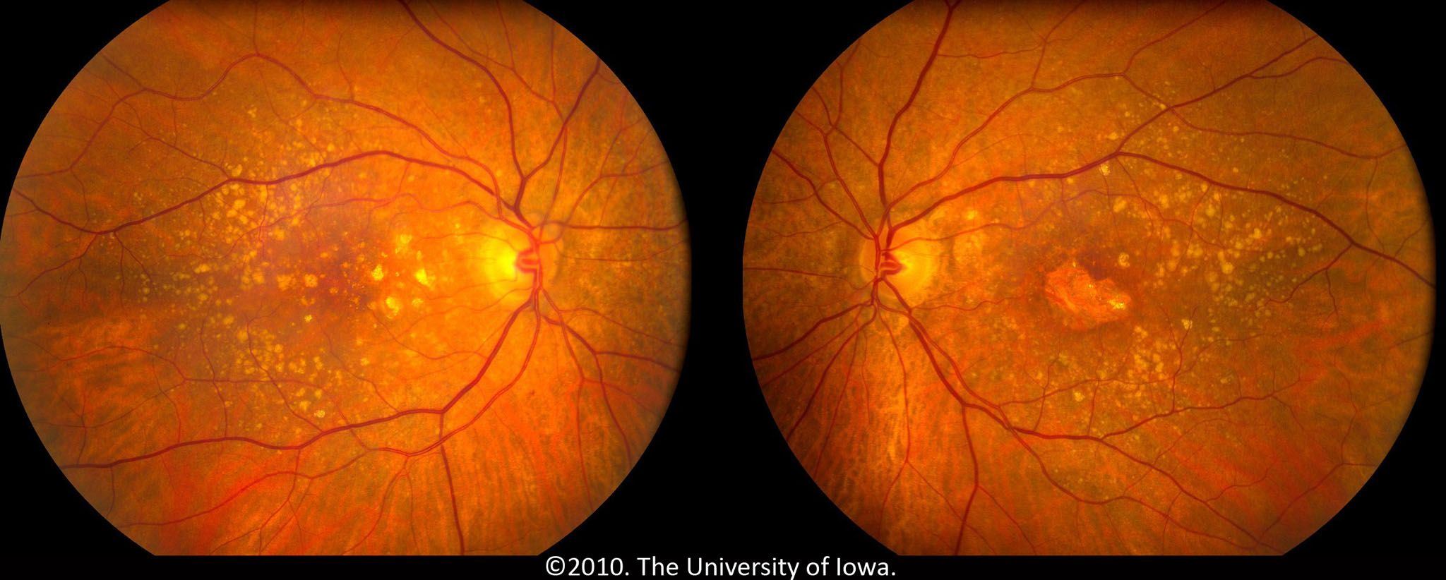 Macular Degeneration