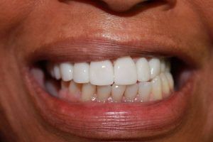 Cosmetic dentistry before-and-after smile results in Spring, TX at America&rsquo;s Family Dental 1