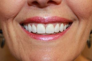 Cosmetic dentistry before-and-after smile results in Spring, TX at America&rsquo;s Family Dental 11