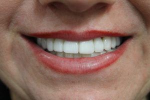 Cosmetic dentistry before-and-after smile results in Spring, TX at America&rsquo;s Family Dental 13