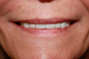 Cosmetic dentistry before-and-after smile results in Spring, TX at America&rsquo;s Family Dental 15