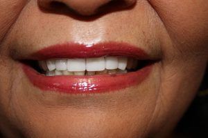 Cosmetic dentistry before-and-after smile results in Spring, TX at America&rsquo;s Family Dental 17