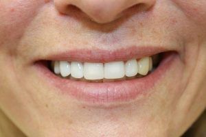 Cosmetic dentistry before-and-after smile results in Spring, TX at America&rsquo;s Family Dental 18