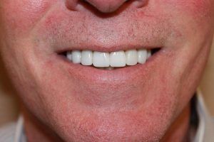 Cosmetic dentistry before-and-after smile results in Spring, TX at America&rsquo;s Family Dental 19