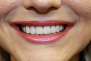 Cosmetic dentistry before-and-after smile results in Spring, TX at America&rsquo;s Family Dental 20
