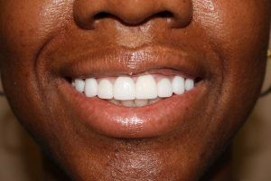 Cosmetic dentistry before-and-after smile results in Spring, TX at America&rsquo;s Family Dental 21