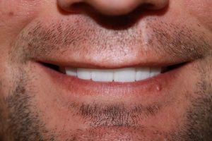 Cosmetic dentistry before-and-after smile results in Spring, TX at America&rsquo;s Family Dental 22