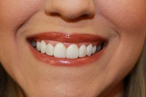Cosmetic dentistry before-and-after smile results in Spring, TX at America&rsquo;s Family Dental 23