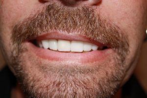 Cosmetic dentistry before-and-after smile results in Spring, TX at America&rsquo;s Family Dental 3