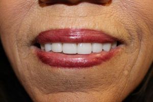 Cosmetic dentistry before-and-after smile results in Spring, TX at America&rsquo;s Family Dental 5