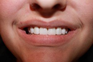 Cosmetic dentistry before-and-after smile results in Spring, TX at America&rsquo;s Family Dental 7