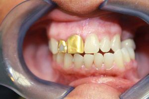 Cosmetic dentistry before-and-after smile results in Spring, TX at America&rsquo;s Family Dental 1