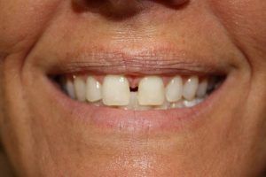 Cosmetic dentistry before-and-after smile results in Spring, TX at America&rsquo;s Family Dental 11