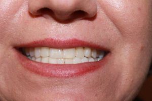 Cosmetic dentistry before-and-after smile results in Spring, TX at America&rsquo;s Family Dental 13
