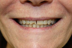 Cosmetic dentistry before-and-after smile results in Spring, TX at America&rsquo;s Family Dental 15