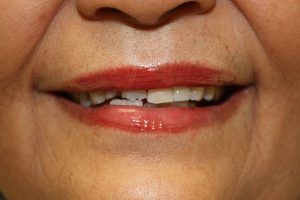 Cosmetic dentistry before-and-after smile results in Spring, TX at America&rsquo;s Family Dental 17