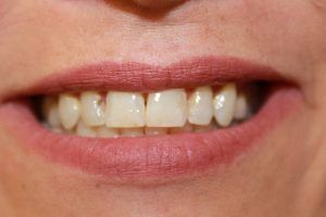 Cosmetic dentistry before-and-after smile results in Spring, TX at America&rsquo;s Family Dental 18