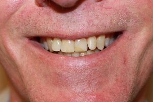 Cosmetic dentistry before-and-after smile results in Spring, TX at America&rsquo;s Family Dental 19