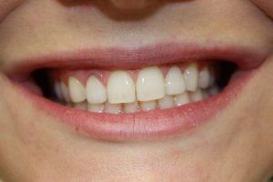 Cosmetic dentistry before-and-after smile results in Spring, TX at America&rsquo;s Family Dental 20