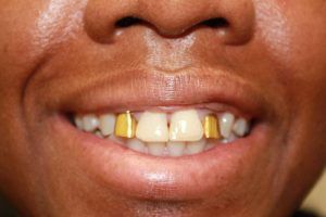Cosmetic dentistry before-and-after smile results in Spring, TX at America&rsquo;s Family Dental 21