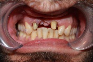 Cosmetic dentistry before-and-after smile results in Spring, TX at America&rsquo;s Family Dental 22