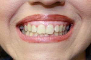 Cosmetic dentistry before-and-after smile results in Spring, TX at America&rsquo;s Family Dental 23