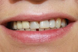 Cosmetic dentistry before-and-after smile results in Spring, TX at America&rsquo;s Family Dental 24