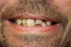 Cosmetic dentistry before-and-after smile results in Spring, TX at America&rsquo;s Family Dental 3