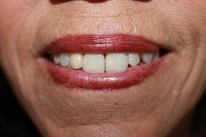 Cosmetic dentistry before-and-after smile results in Spring, TX at America&rsquo;s Family Dental 5