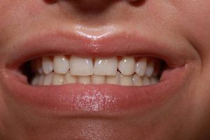 Cosmetic dentistry before-and-after smile results in Spring, TX at America&rsquo;s Family Dental 7