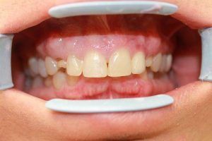 Cosmetic dentistry before-and-after smile results in Spring, TX at America&rsquo;s Family Dental 9
