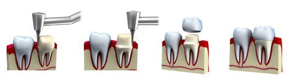 full mouth reconstruction