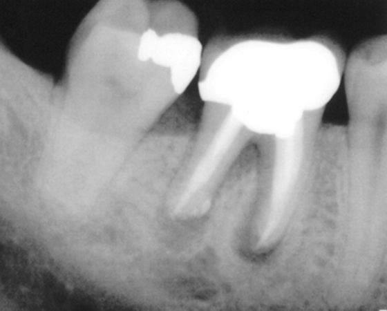 Root Canal Therapy