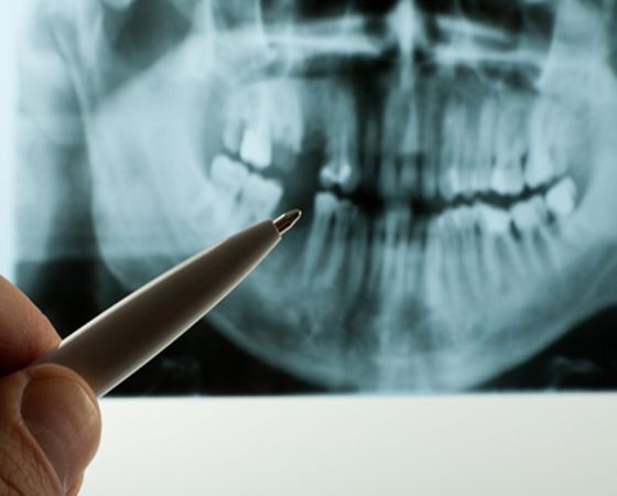Single Tooth Extractions