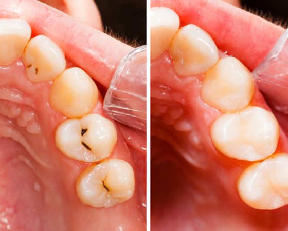 Tooth-colored Fillings