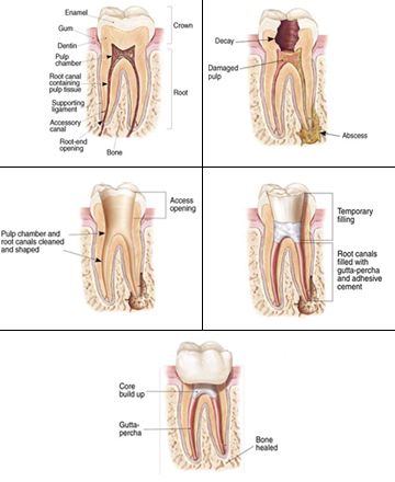 root canal therapy infograph