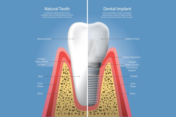 dental implants graph