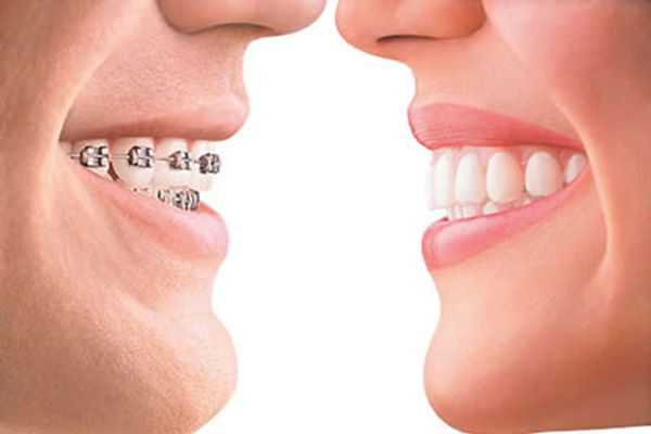 The Advantages of Clear Braces