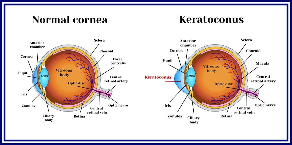 keratoconus chart
