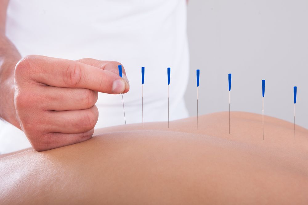 What Are the Benefits of Acupuncture?