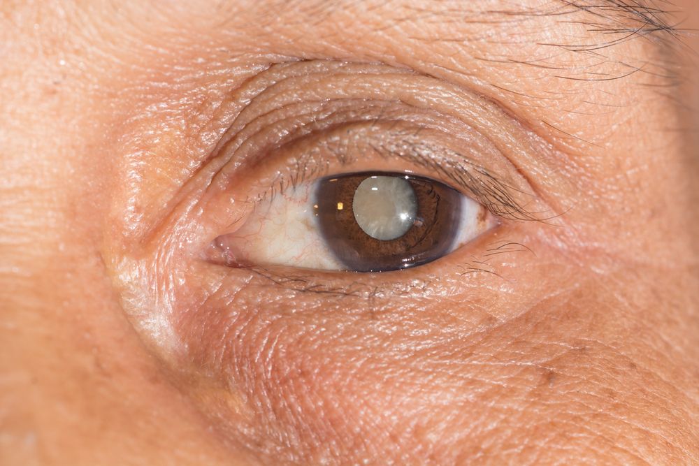 Can Cataracts Cause Other Health Problems?